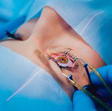 LASIK Eye Surgery