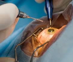 Cataract Surgery