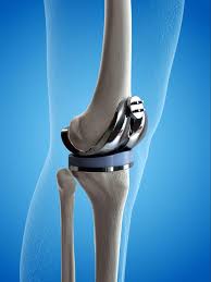 Knee Replacement Surgery